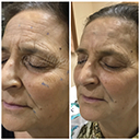 anti aging treatment