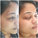 Silkpeel hydrafacial